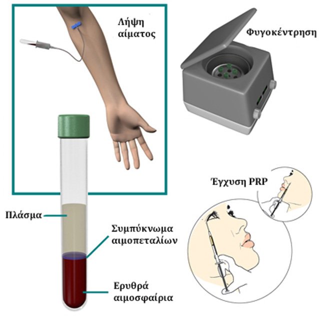 autologi-meso8erapia_new-2