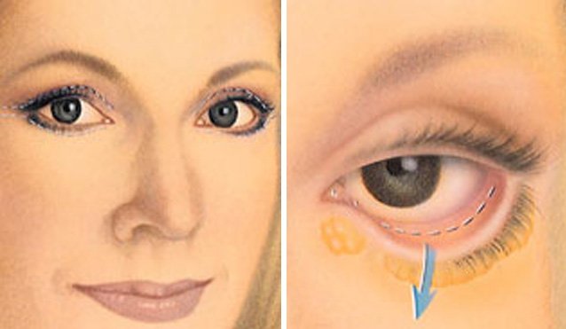 blepharoplasty_new-5