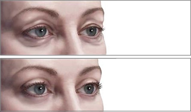blepharoplasty_new-7