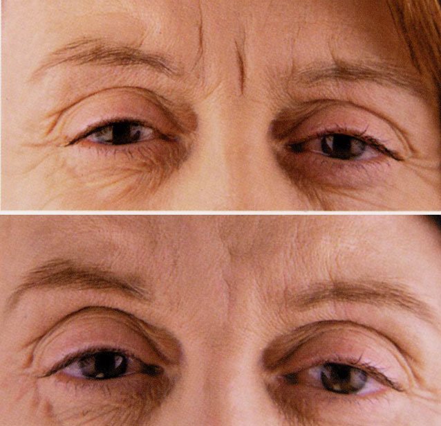 hyaluronic2