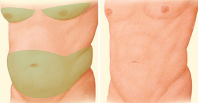 lipoanarofisi