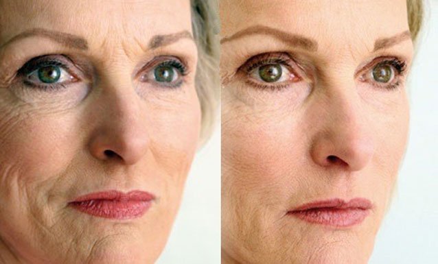mesotherapy_new2