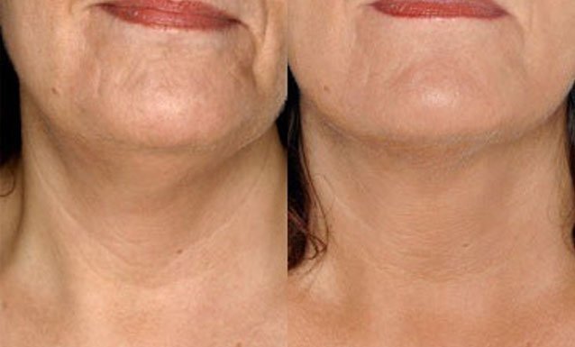 mesotherapy_new3