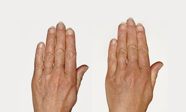 mesotherapy_new4