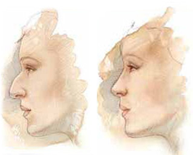 rhinoplasty_new-04.1